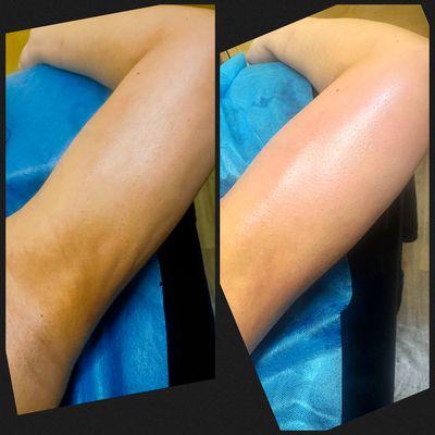 Before and after one lymphatic drainage massage