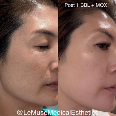 Broadband light + MOXI laser