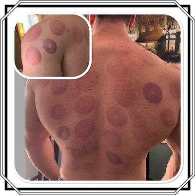 Cupping therapy on client who is constantly in the gym to build muscle.