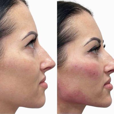 Jawline, chin, cheek filler