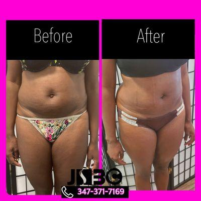 Noninvasive Abdominal fat reduction