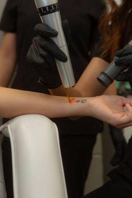 Laser tattoo removal treatment.