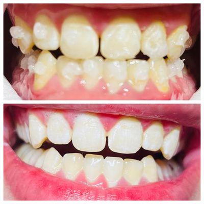 Client 30 min session! Everyone teeth enamel is different. My job is to get your teeth white as I can with multiple sessions.