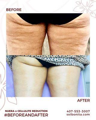 NuEra Body Sculpting Before and After