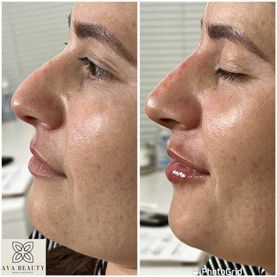 Nose and lip filler