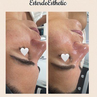 Dermaplaning facial. Before/After