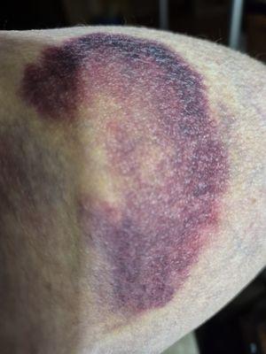 Bruise from IV site days after procedure.