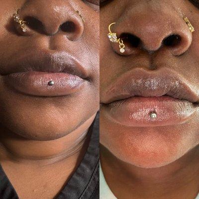 Before & after ! Micro needle lip filler ! Very natural
