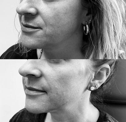 Nasolabial Filler/ Smile Lines