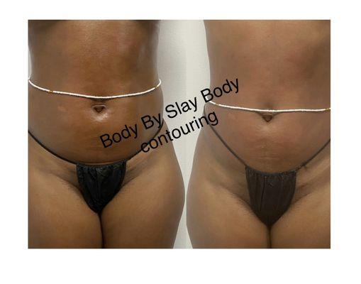 Laser Lipo Package / Plus wood Therapy