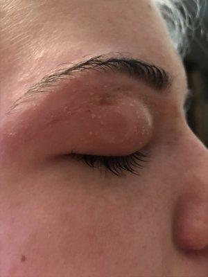 Waxed daughter's eyebrows w/o perm. When I went to bathroom caused severe damage many DR visits & Meds