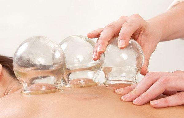 Cupping