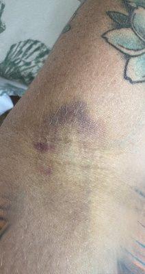 A huge bruise