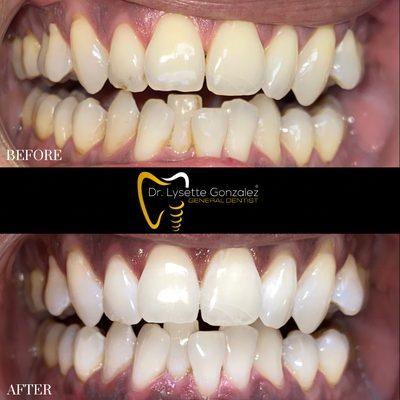 Before and after our In-house Zoom teeth whitening!