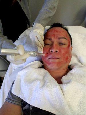 Miconeedling uses fine needles to create micro-channels in your skin. It improve skin by producing natural collagen and elastin.