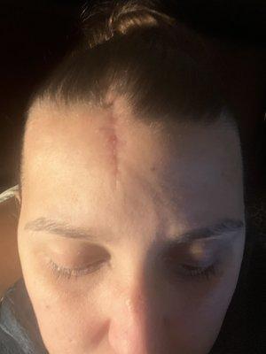 Skin cancer in my forehead