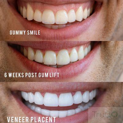 Gum lift and veneers