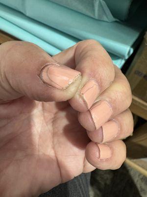 This is one day after manicure.