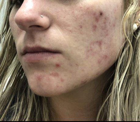 Before Lauring Dermatology