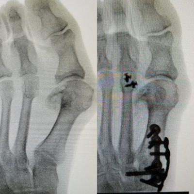 Sometimes it's not enough to just correct the bunion. With this patient we made sure the ball of her foot pain was gone as well