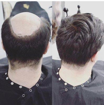 Non surgical men's hair replacement