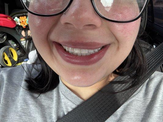 THE WAX HAS CAUSED MY LIPS TO BE UNEVEN AS WELL AS BALLS FORMING IN THE INSIDE OF MY BOTTOM LIP