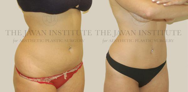 Liposuction, Abdomen & Waist.
Patient now has a smaller and more contoured figure. Beautiful results!
