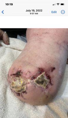 I told Prince Esiobu, MD , that my Uncle Is Allergic To Staples !!!! , My Uncle told him . He put them in ANYWAY!!!