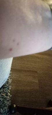 This is showing the bedbug problem that I am still suffering with to this day