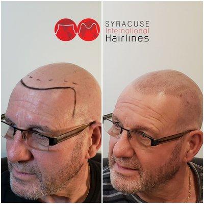 Scalp International Hairlines