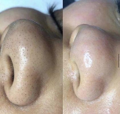 My blackheads removed