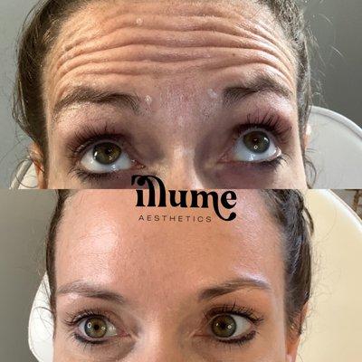 Smooth forehead lines