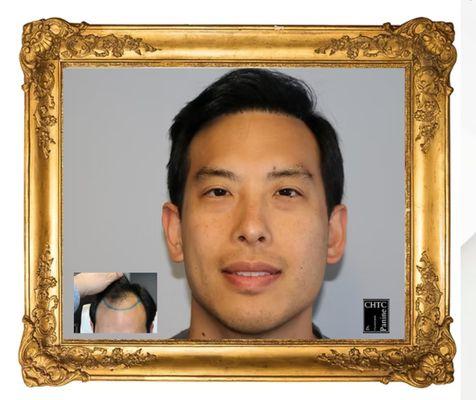 Chicago Hair Transplant Clinic