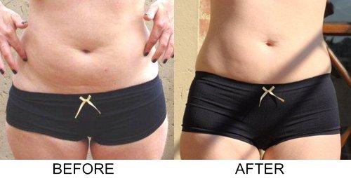 Reduce visible signs of cellulite in just one visit.