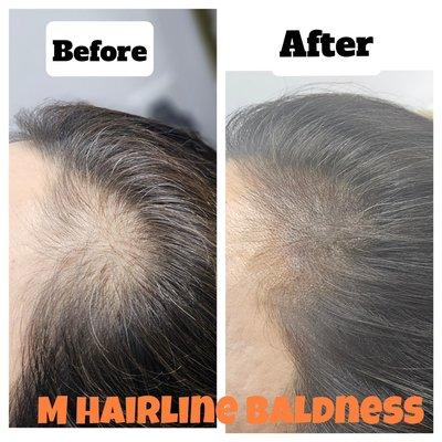 Covered M-shaped baldness with scalp tattoo.