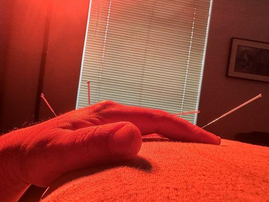 The hand I injured with four acupuncture needles and a heat lamp.