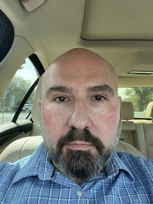 After under eye filler. Thank you Dr. Lupo, this was exactly the refreshing treatment I was hoping for.