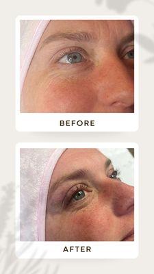 Lash lift