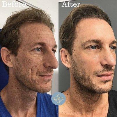 Microneedling