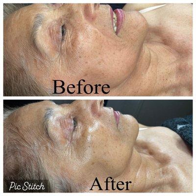 Our client before and after our Carboxy treatment