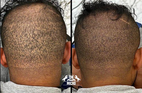 FUE scar cover up with SMP