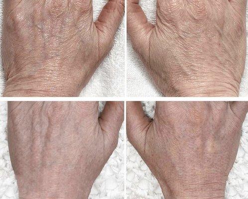 Get rid of crepey skin