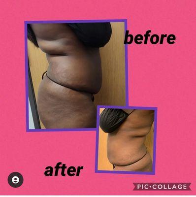 1 session Laser Lipo