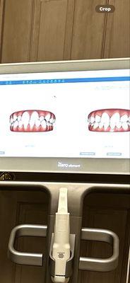 Patient teeth before and after