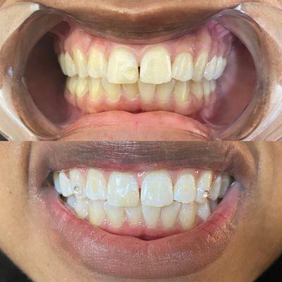 Teeth whitening and gem, book Fancy Smile
