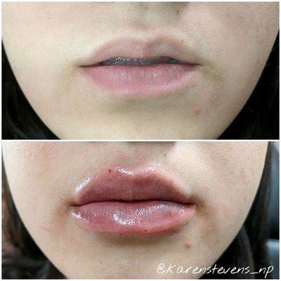 Lip filler before and after