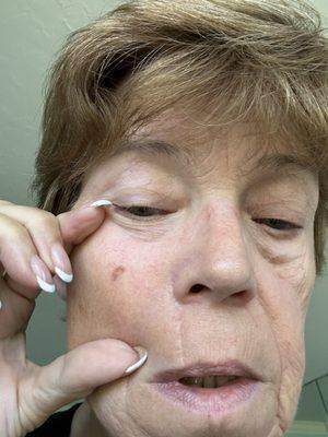 Scar on my right cheek. 6 months after !