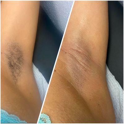 Before and after underarm wax