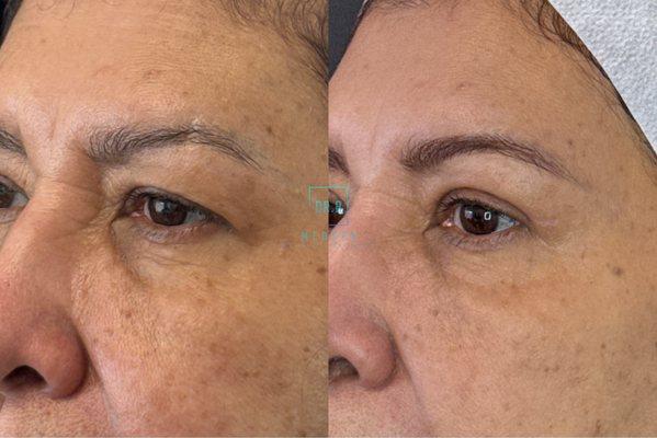 Before and After of upper eye lid surgery. 6 weeks