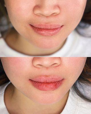 Before & After Lip Filler